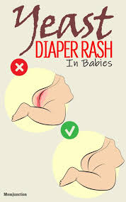 12 Effective Ways To Treat Diaper Rashes In Babies Yeast Diaper Rash Baby Diaper Rash Treating Diaper Rash