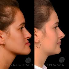 Şiddetli mandibular prognati ile birlikte class III malokluzyona sahip  hastamızın tedavisini ortodonti ve ortognatik cerrahi operasyonuyla  tamamladık. Yeni hayatında hep mutlu olman dileğiyle... 😊 . .We completed  the treatment of our patient