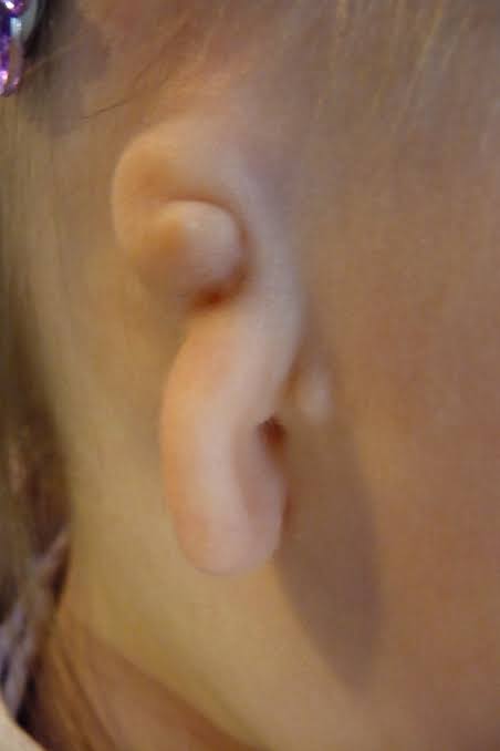 Microtia & Atresia | صغر الأذن Microtia