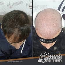 Pin By Promed Hair On Sac Ekimi کاشت مو Hair Transplant Trapianto Di Capelli Haartransplantation زراعة شعر Hair Transplant Hair Capelli