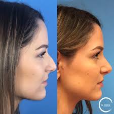 This patient wanted a more feminine nose with narrowing of the tip and reduction of a hump. Nose Job Cambridge Ma Plastic Surgeon Dr Markarian