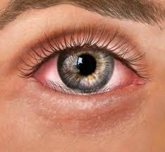 Image result for Entropion