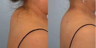 How To Get Rid Of Buffalo Hump Buffalo Hump Spine Alignment Neck Exercises
