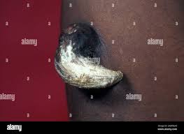 Image result for cornu cutaneum)