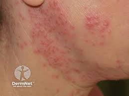 Image result for Atopic eczema atopic dermatitis