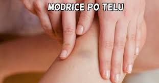 Zatim na povređeno mesto treba staviti led. Modrice Po Telu Bez Razloga I Nogama I Rukama I Kod Dece