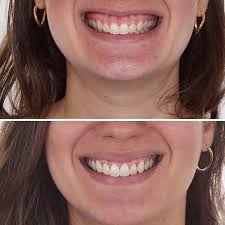 Repost @odontoclub with @repostapp Mais um caso sensacional do @dr. felipe.bezerra ! Repost: TRANSFORMAÇÃO DO SORRISO com Aumento de Coroa Um  Sorriso não é composto apenas de dentes mas sim pela relação deles