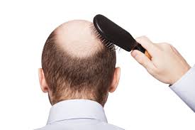 Scientists study the origins of hair loss in hopes of one day discovering a cure. Cure For Male Baldness With No Sexual Side Effects Israel21c