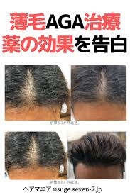 薄毛aga治療の体験談告白 ミノキシジル服薬の効果はいかに aga 治療 治療 薄毛