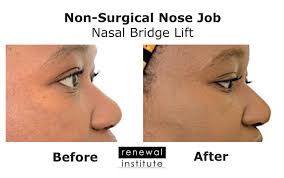 No complicated software to download or install. Nose Job Non Surgical 3d Rhinoplasty
