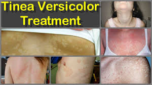 The patches most often occur on the chest or back. Top 10 Tinea Versicolor Treatment Options That Really Work Naturally Youtube