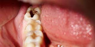 Gusi bengkak dapat disebabkan oleh gigi yang berlubang. 14 Cara Mengatasi Gigi Berlubang Dengan Bahan Alami Mudah Didapat Merdeka Com