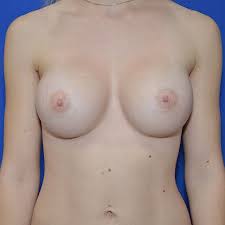 Brustvergrößerung: Vorher Nachher Fotos - Perfekte Brust®,  Brustvergrößerung & Bruststraffung Wien