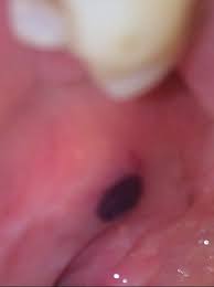 Blood blister inside cheek pictures. Blood Blisters In Mouth Evening All I Really Lupus Uk