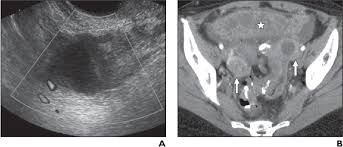 Do get back to us if we can help further. Figure 1 From Mri Ct And Pet Ct For Ovarian Cancer Detection And Adnexal Lesion Characterization Semantic Scholar