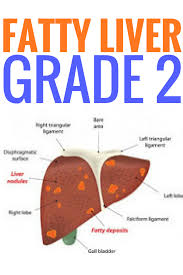 Fatty Liver Grade 2 Fatty Liver Diet Fatty Liver Cleanse