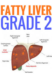 fatty liver grade 2 fatty liver diet fatty liver cleanse