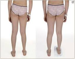 Image result for Functional Leg Length Discrepancy