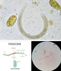 Cocuklarda Kil Kurdu Oksiyur Pinworm Uz Dr Dundar Yaykiran
