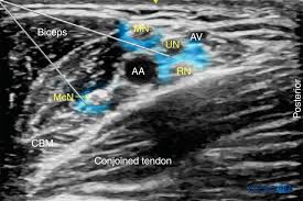 Image result for Axillary Nerve Block