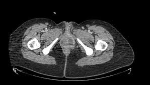 Image result for Bartholin's gland abscess