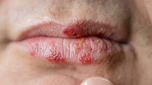 Image result for oral herpes symptoms roof of the mouth