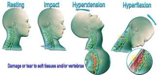 Whiplash may be called a neck sprain or strain, but these terms also include other types of neck injuries. Whiplash What How Treatment Symptoms More