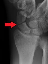 Scaphoid Fracture Wikipedia The name originates from the use of this surface for placing and then sniffing powdered tobacco, or. scaphoid fracture wikipedia