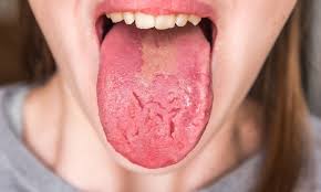 Image result for Fissured tongue
