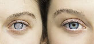 People who have a family history of glaucoma: What Is Glaucoma Family Eye Physicians