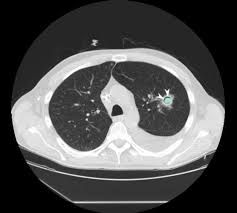 Invasive pulmonary aspergillosis (ipa) is one of the major complications in immunocompromised patients. Aspergillosis Amboss