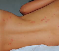 Image result for wolf spider bite skin