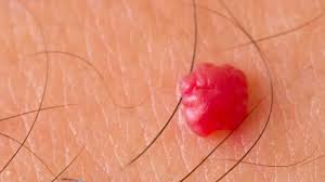 Cherry angiomas are usually multiple. Cherry Angioma Treatment Removal In Bristol By Pro Clinics