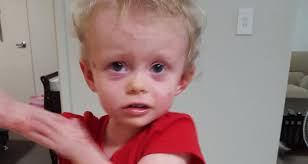 Mum's heartbreak: My little girl is allergic to me