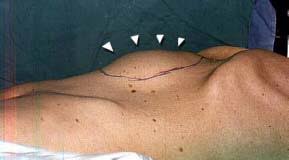 Um diferencial é que o profissional também poderá solicitar um ecocardiograma, já que aneurismas torácicos costumam estar perigosamente relacionados com o coração. Aneurisma Arterial E Sua Importancia Tratamento Em Curitiba