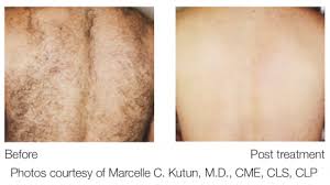 Candela's gentlemax system is the culmination of the recognition of excellence for candela's two world renowned laser systems: Candela Gentleyag Mclean Woodbridge Va Skin Laser Dermatology Center