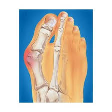 как лечить косточку на ноге в домашних условиях отзывы Hallux Valgus Valgusnaya Deformaciya Pervogo Palca Stopy Otzyvy Pokupatelej