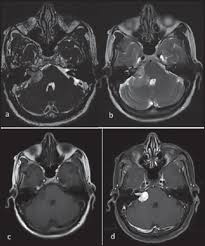 Acoustic neuroma or schwannoma vestibular is benign tumour from. Magnetic Resonance Imaging Of Cerebellopontine Angle Lesions