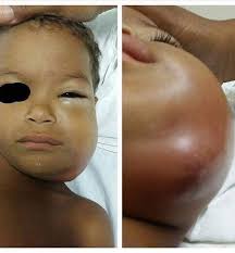 Not taking a Baby to the Dentist is a form of abuse. Dental Infections can  arise as soon as the first tooth erupts. Parents should strictly consult a  dentist because these Infections