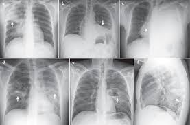 Image result for Pneumonia