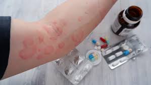Drug Allergy Self-Care : Effective Home Remedies at Home