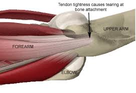 Forearm tendons are very sore in my elbow. Forearm Tendon Tightness