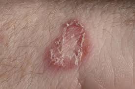 Does hand sanitizer work against viruses? Tinea Manuum Pictures Symptoms And Treatments