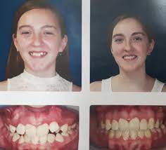 How to disinfect retainer reddit. Teeth Shifted After Braces Reddit Teethwalls