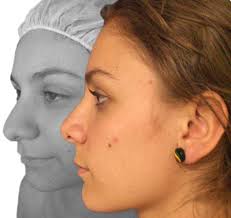 Rinoplastia
