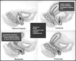 It's Not All About Birth: Biomechanics Applied to Pelvic Organ Prolapse  Prevention - O'Dell - 2008 - Journal of Midwifery & Women's Health - Wiley  Online Library