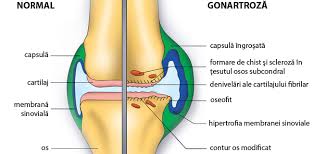 Tin sa precizez ca stau foarte mult in picioare. Durerea De Sold In Timpul Noptii Cauze Simptome Si Tratament Durere BruscÄ In Genunchi Pe Timp De Noapte