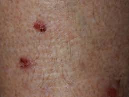 The term morgellons was coined in 1674 by sir thomas browne in morgellons disease is characterised by individuals describing filaments of various colours growing. Morgellons Disease Dermnet Nz