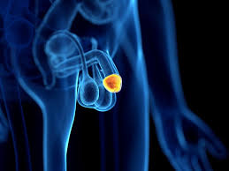 Image result for Penile Cancer