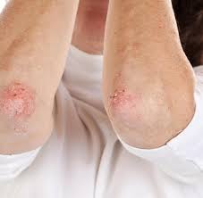 Hautpilz News Ratgeber Zu Symptome Diagnose Behandlung Welt